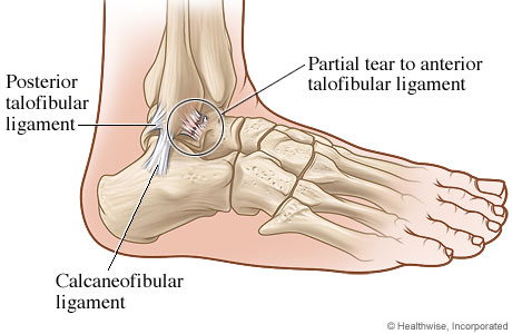 Partial Ligament Tear In Foot